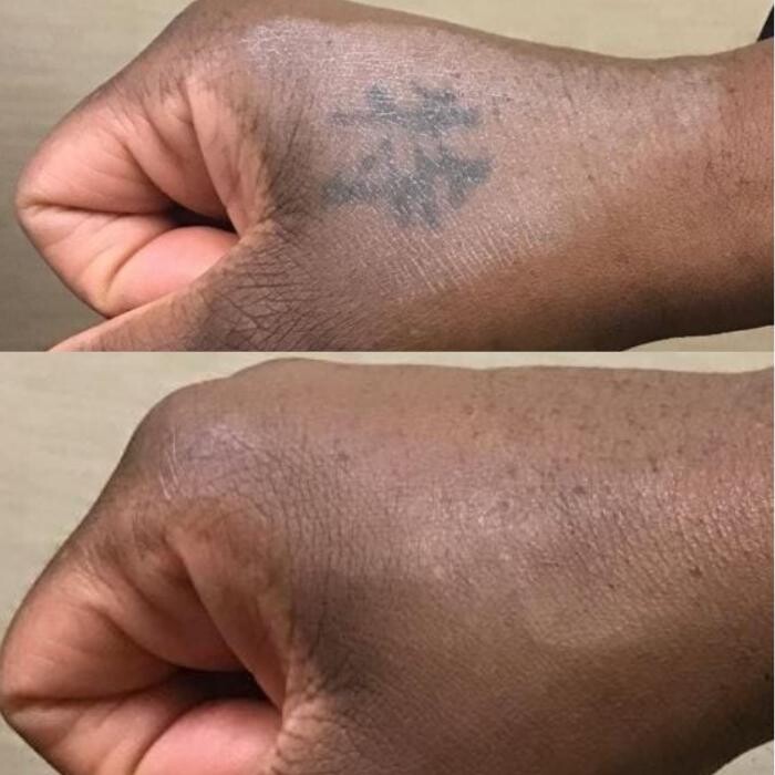 Images Removery Tattoo Removal & Fading