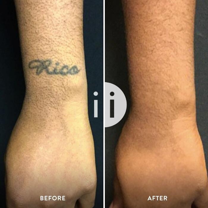 Images Removery Tattoo Removal & Fading