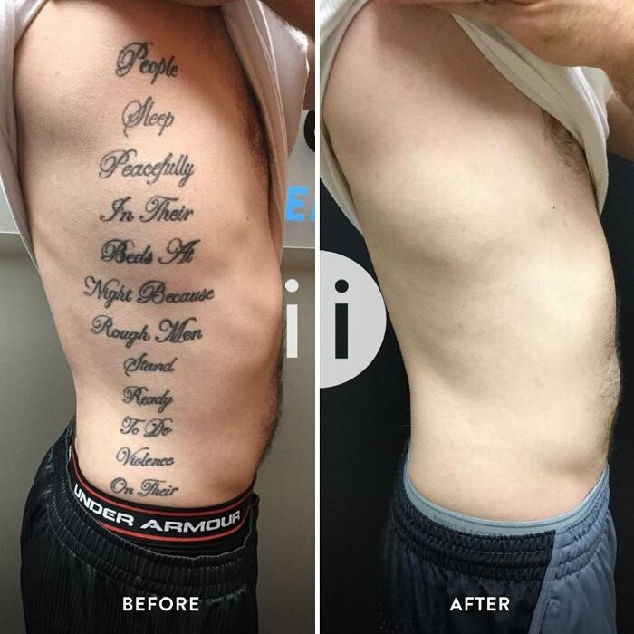 Images Removery Tattoo Removal & Fading
