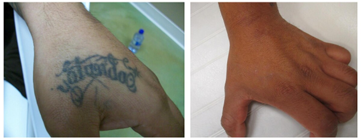 Images Removery Tattoo Removal & Fading
