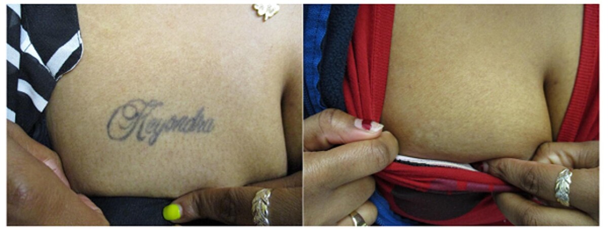 Images Removery Tattoo Removal & Fading