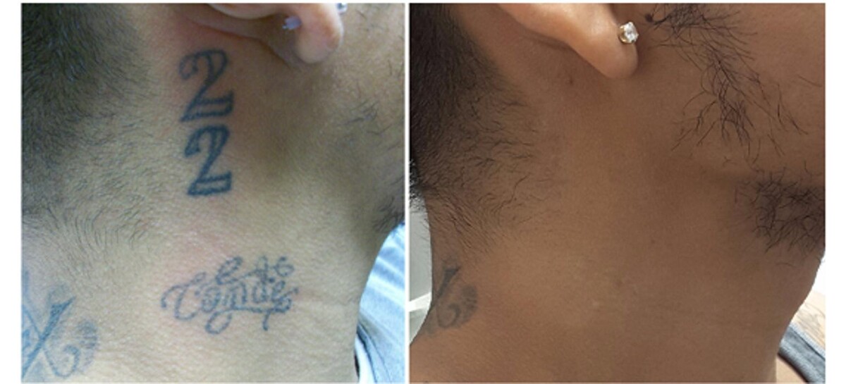 Images Removery Tattoo Removal & Fading