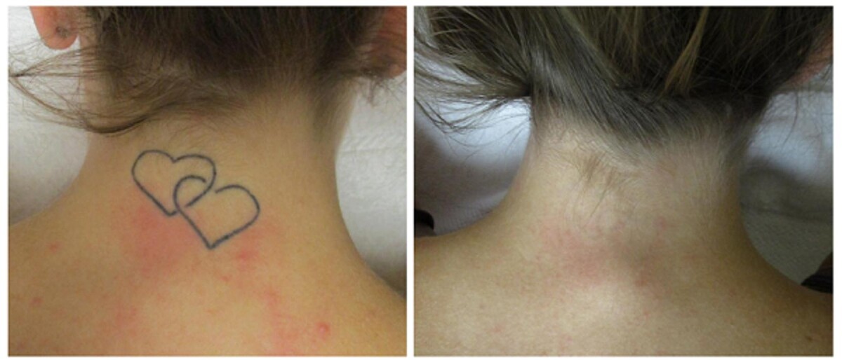 Images Removery Tattoo Removal & Fading