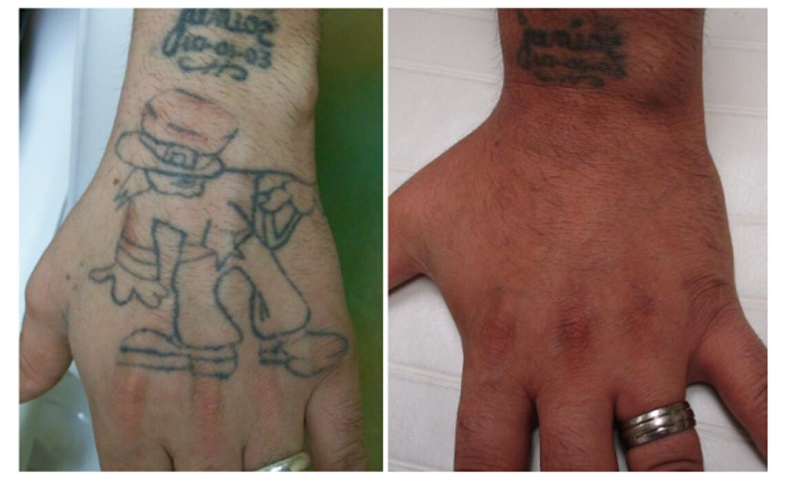 Images Removery Tattoo Removal & Fading