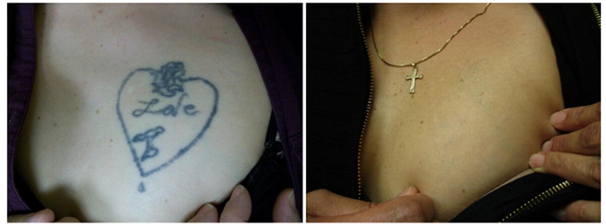 Images Removery Tattoo Removal & Fading